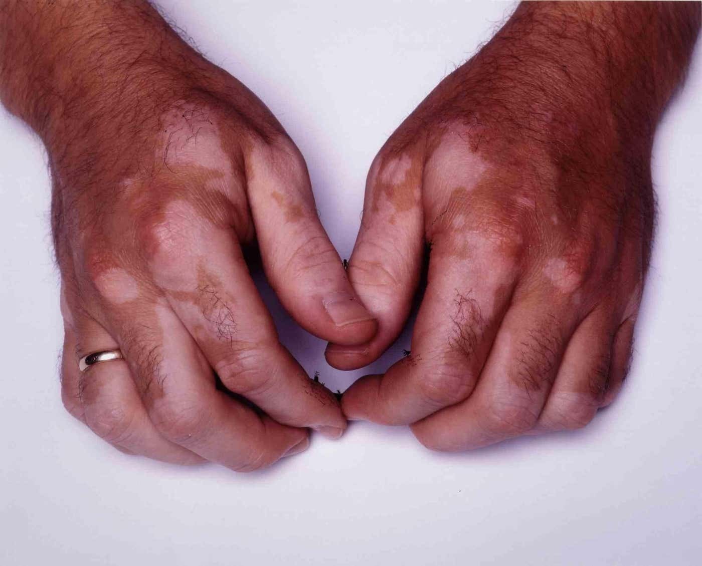 Nedko Solakov, Vitiligo people #4 Nedko Solakov, Vitiligo people #4